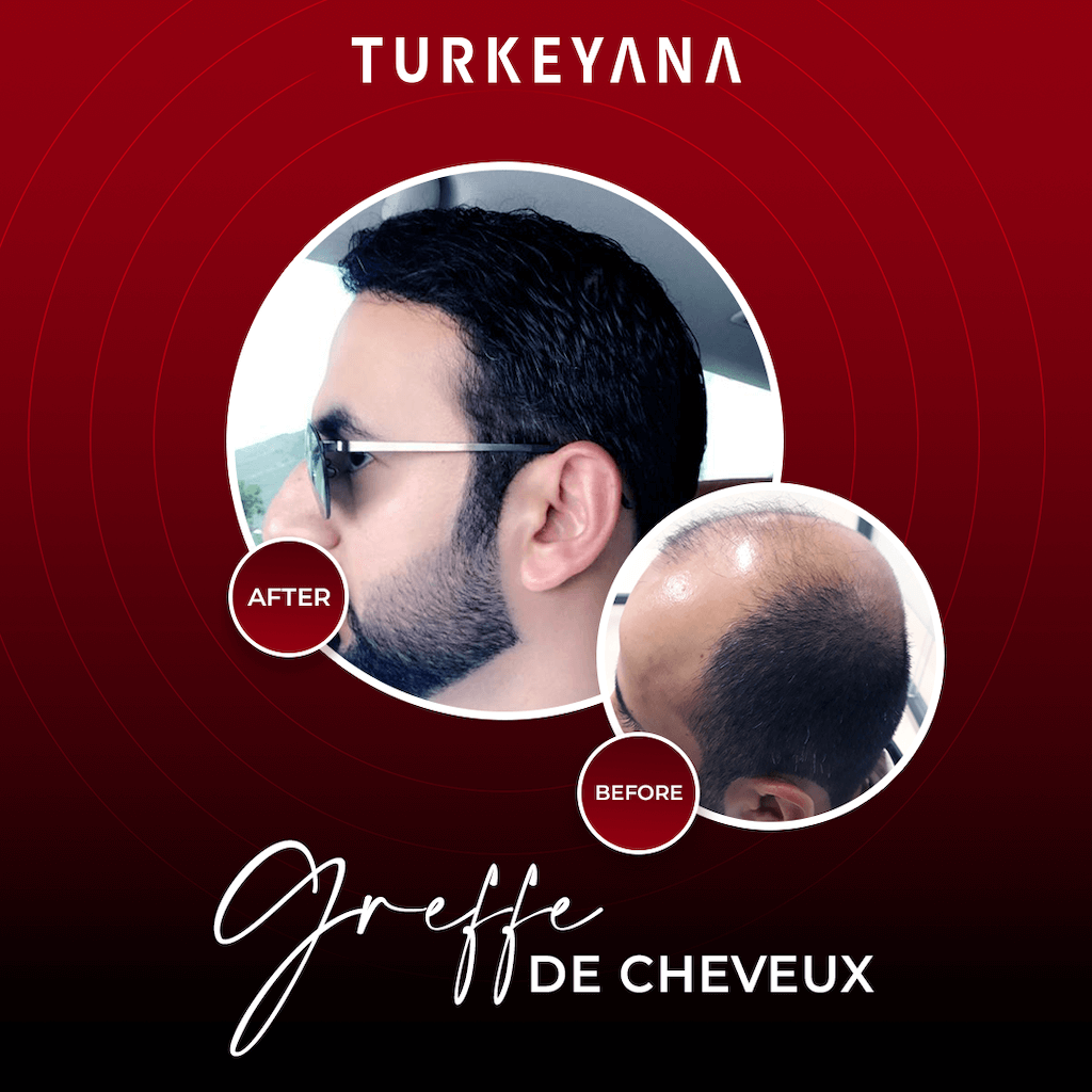 Turkeyana Clinic team uses state of the art techniques such as FUE Follicular Unit Extraction and DHI Direct Hair Implantation Methods 2023 - Turkey Life