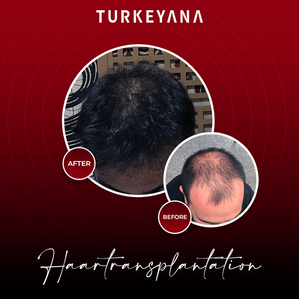 Turkeyana Clinic is a leading aesthetic clinic in Istanbul specializing in hair transplant 2023 - Turkey Life